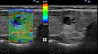 соноэластография